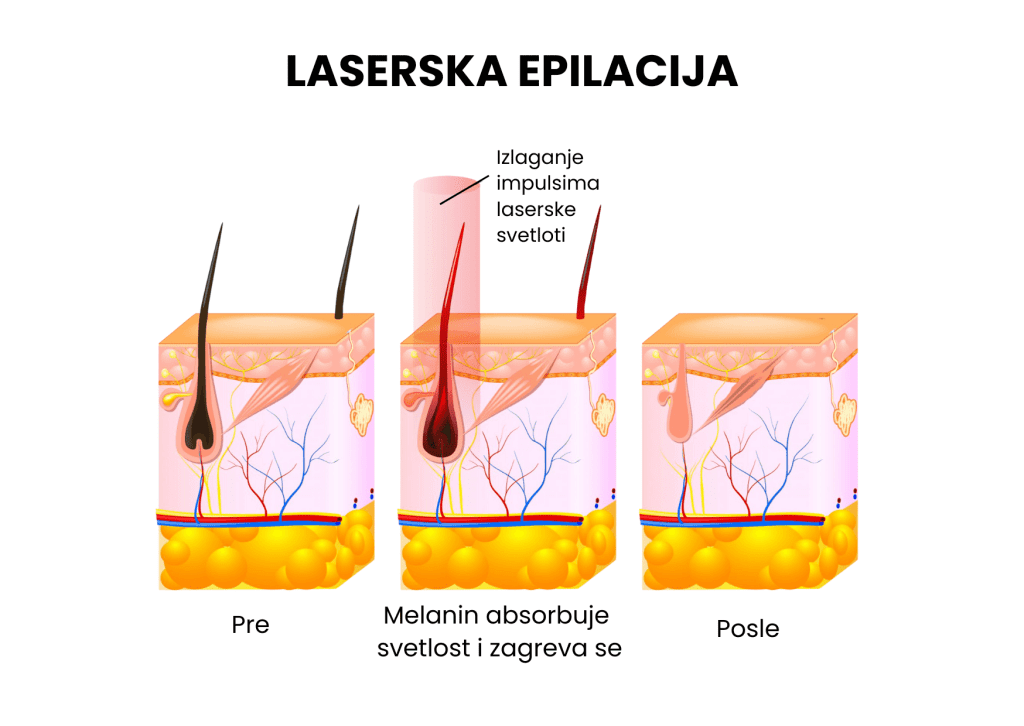 Proces Laserske Epilacije U Beogradu