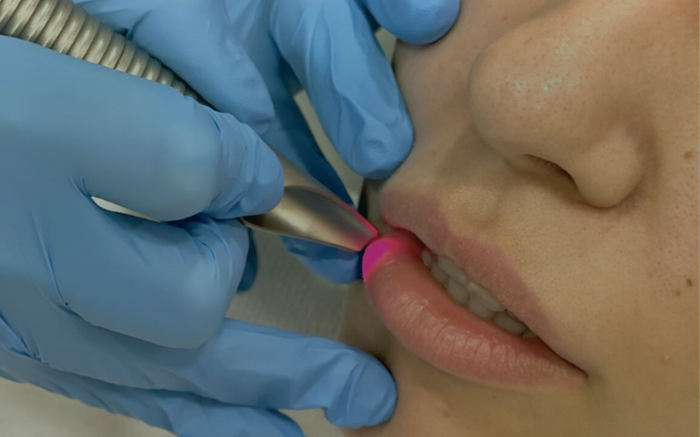 Fotona Lips laser