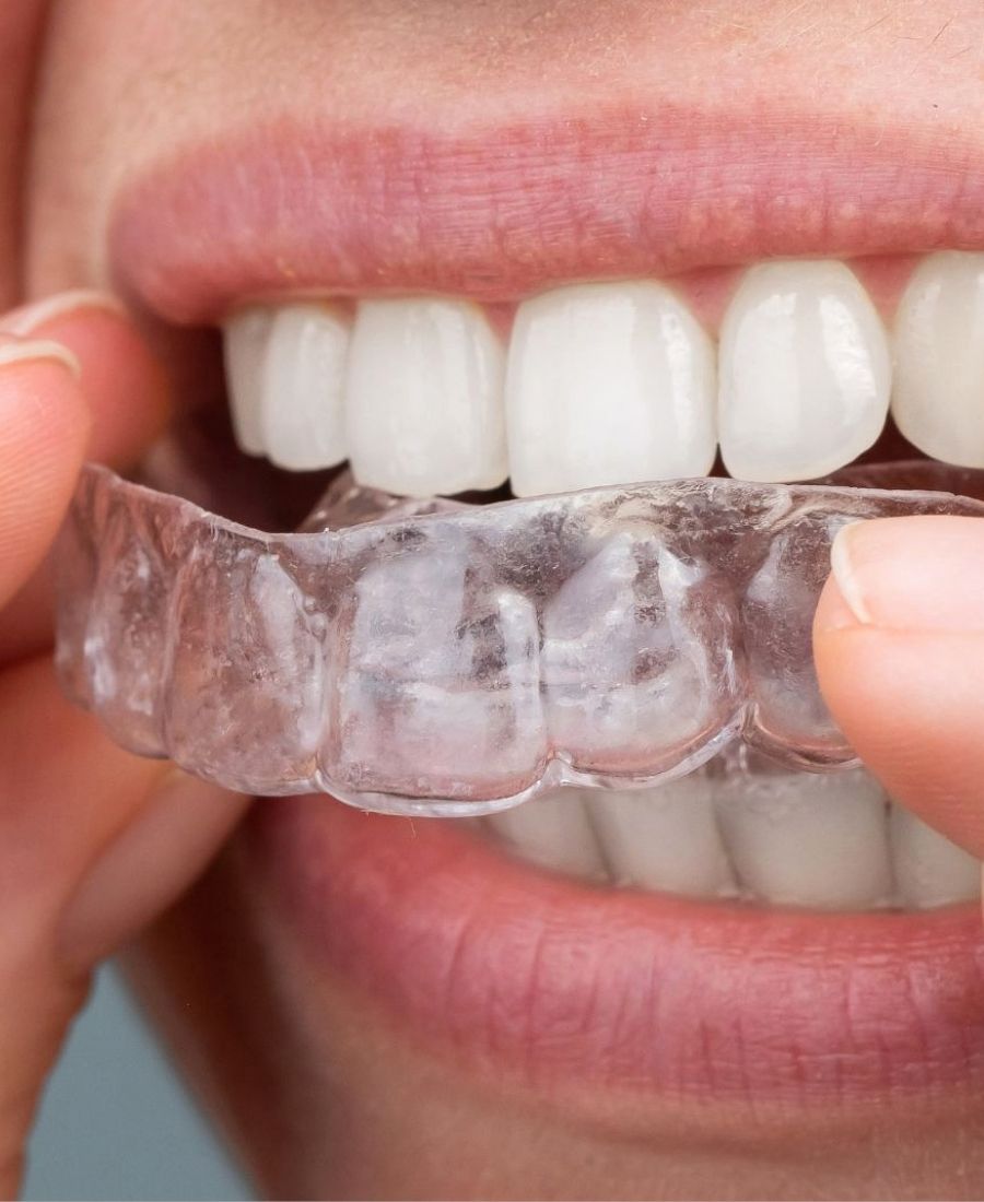 Invisalign — providne folije za zube